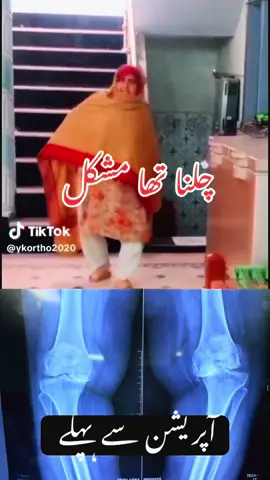 #dryasirkhan #ykorthopaedics #qualityoflife #clinic #patient #sargodha #gujranwala #lahore #gujrat #arthroscopy #sahiwal #deraismailkhan #karachi #quetta #bhawalpur #foryoupageofficiall❤️❤️tiktok #kneesurgery #kneereplacement #kneepainrelief 