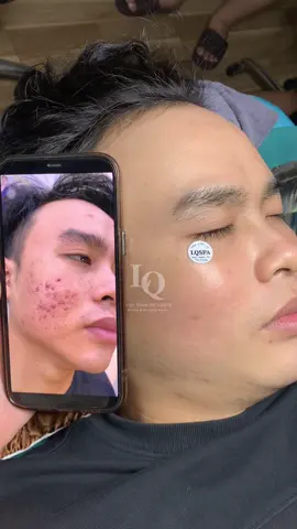 Cập nhật da mụn thâm sẹo #chamsocdaseo#chamsocda#chamsocdamun#chamsocdanam#tanbinh#govap #Lequynh#Lqspa#hocnghespa  #chamsocda #lequynhspa #vienthammylqspa #nanmunbangtay #nanmunbangtambong#nanmunbangcay