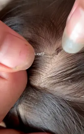 #removalice #tiktok_india #lice #omg🥶 