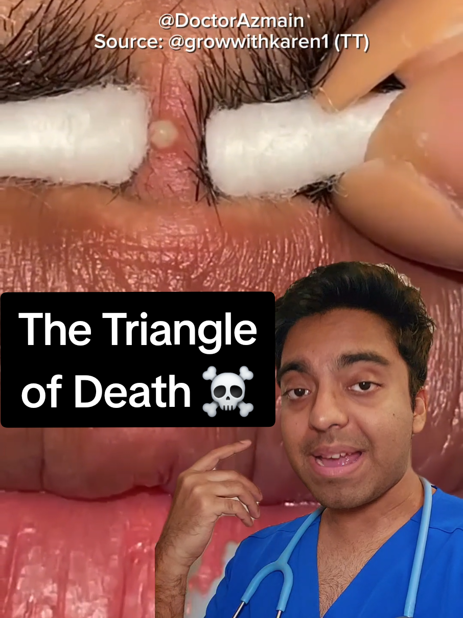 🚨☠️ NEVER Pop a Pimple Here: the Triangle of Death  This isn't a joke—popping a pimple in this area could have deadly consequences. 😱 The blood vessels in the 