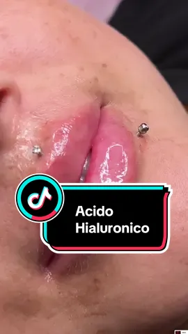 Antes y después de labios! #👄 #lipfiller #rellenodelabios 