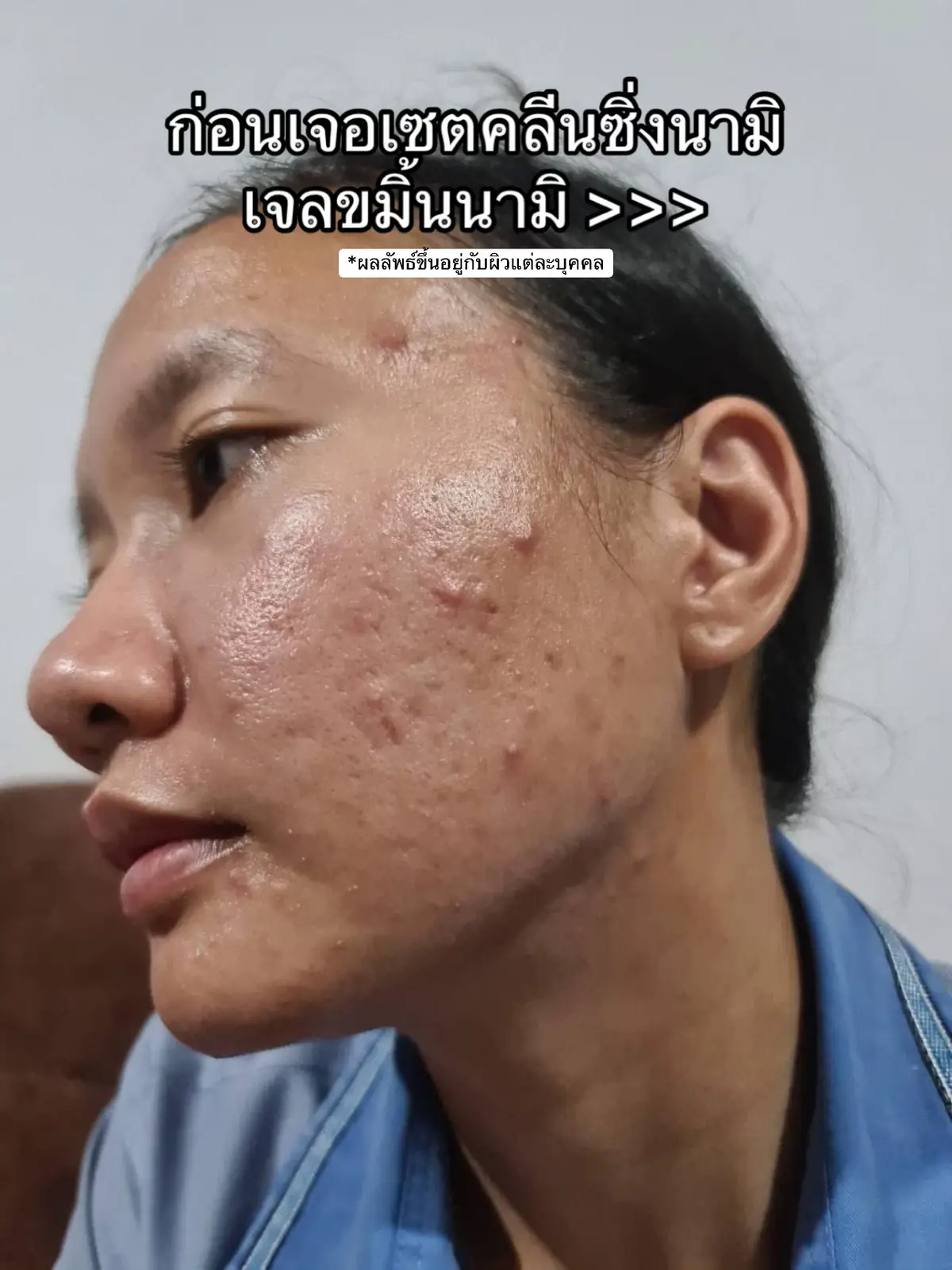 #คลีนซิ่งนามิ #เจลขมิ้นนามิ #สบู่นามิ #สิว 