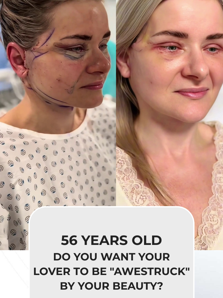 #cosmeticsurgery #fullfacelift #rhinoplasty #facelift #necklift #eyebrow #eyelid #liposuction #abdominalliposuction #fullbodyliposuction #fatgrafting #surgery #chin #Facelift #fullface #indonesia #lips #drlinhk