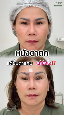 หนังตาตก แต่ชั้นตาแคบแก้ยังไง⁉️ #fernclinic #รีวิวเฟิร์นคลินิก  #เย็บแผลซ่อนไหม  #directbrowlift #ทีมแพทย์เฟิร์นคลินิก