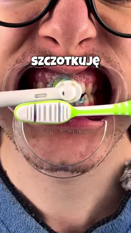 Szczotkuję zęby, aż będą idealnie białe dzień 9! Link do zakupu szczoteczki znajduje się w opisie mojego profilu. Aktualnie trwa na nią promocja -49%!