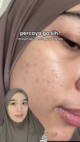 siapa yang lagi punya skin concern kek akuu boleh bgt nih kalian coba skincare satu inii✨ #skincarekorea #SpringOrigin 