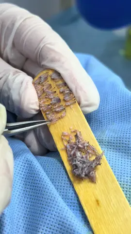 Dr mohib hair transplant clinic temargara #fyp 
