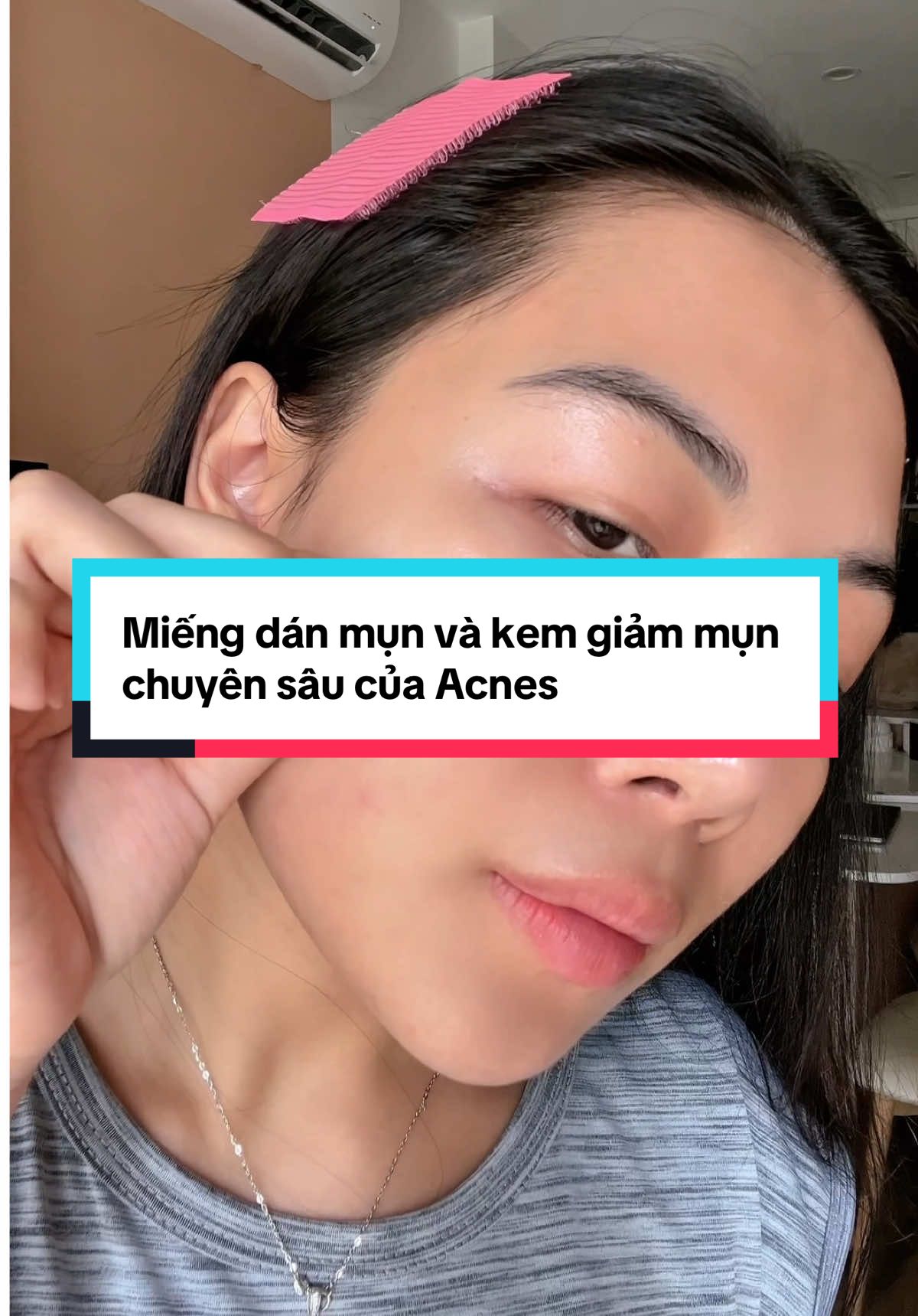 Mún mụn bay nhanh thì cứ combo miếng dán mụn với kem giảm mụn chuyên sâu này mn nha #AcnesLab #Acnes #AcnesVietnam