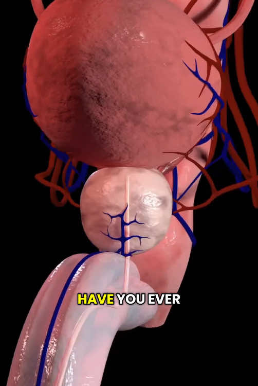 Prostate Artery Embolization (PAE)  #prostat #artery #embolization #shrink #supply #blood #doctor #surgeon #surgery #compare #anesthesia #hospital #medical3danimation #3dmedicalanimation 