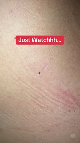 Watch this blackhead pop right out of my boyfriends back 👀 using the Dr. Melaxin Peel Shot!  #drmelaxin #blackheadremoval #peelshot  #blackheadpop #porecleanse  #oddlysatisfying @Dr.Melaxin Global 