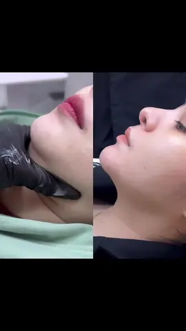 Giải quyết nọng cằm sau 15 ngày tiêm . Khách đang bị tình trạng nọng cằm khiến gương mặt to tròn và không nhỏ gọn tham khảo dịch vụ này nha 💉  #tienleacadamy #filler #botox #tienle #tiemmoifiller 