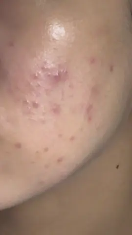 아무나 제발 도와주세요 피부가 나아졌다가 다시 뒤집어졌어요 ㅠㅠㅠ 이렇게 볼 전체에 좁쌀같은 작은 여드름이 퍼져있는 건 어떻게 해야 사라지나요 제발 도와주세요... #피부 #관리 #여드름 #트러블 #고민 #도와주세요 #제발 #추천 #추천추천추천추천추추천추천추천추천 #ㅊㅊ 