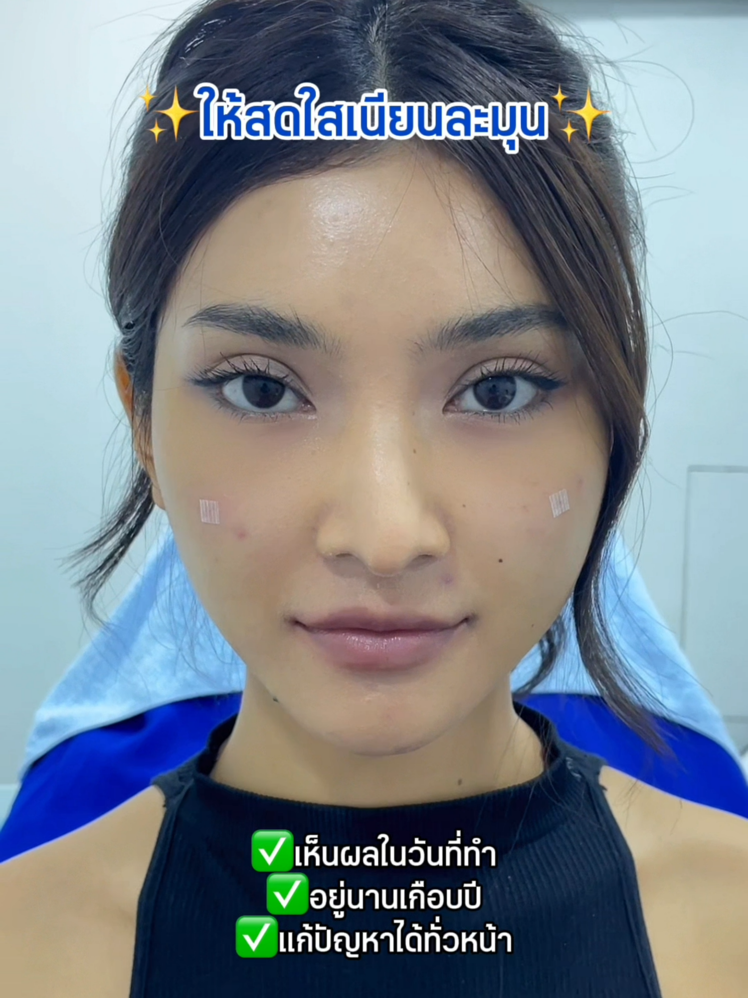 ใต้ตาเป็นร่องเป็นแอ่งชัดมากกกก แบบนี้ต้องแก้ด้วย ... #charmerclinic #รีวิวบิวตี้ในtiktok #รีวิวบิวตี้tiktok #ฟิลเลอร์ใต้ตา #รีวิวฉีดฟิลเลอร์ #ฉีดฟิลเลอร์ใต้ตา #ใต้ตาคล้ำ #ใต้ตาดํา