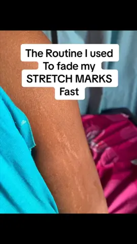 💫 Stretch marks? We don’t know her. Fade & nourish with this magical trio: ✨ Vanishing Cream ✨ Shea Butter ✨ Vitamin E Oil #StretchMarkSolution #GlowNaturally #stretchmarks #skinproductskenya #bodyproductskenya 