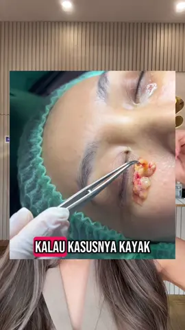 Bulan ini waktunya upgrade diri! Hempaskan lemak membandel & kencangkan kulit wajahmu dengan promo spesial Skin & Fat Undereye Treatment hanya di Serre Beauty 💕 📆 Berlaku sepanjang bulan ini, jangan sampai ketinggalan! #fyp #eyebags #treatmenteyebag #serrebeauty #treatmentkantungmata 