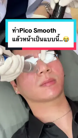 Pico smooth 1,599.- ทำแล้วหน้าแบบนี้😭 #AuraXpress #pico #picolaser #พิโค่เลเซอร์ #พิโค่ #หน้าเนียน #รูขุมขนกระชับ 