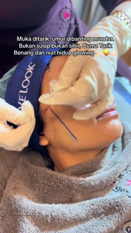 Book  your appointment now dan  langsung treatment di Fs Beauty Clinic💙✨ thank you sudah mempercayakan tindakany di @fs_beautyclinic_ ❤️❤️❤️🥰 Semakin glowing & fresh dibulan Agustus 2025 ini ya!! 🥰 See you at Fs Beauty Clinic✨💙 More info: 📲 088287023397 📍Jl.panglima Polim no. 24 segala mider, bandar Lampung  #fsbeautyclinic #tanambenanghidung #tanambenangwajah #fillerhidung #fillerdagu                  