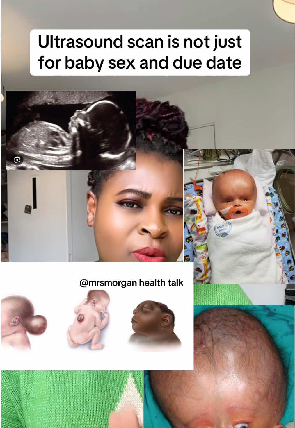Ultrasound scan is very important in pregnancy journey,it reveals some abnormalities a fetus is carrying which helps parents make better decisions,be cautious of where you take your scan as a pregnant woman #creatorsearchinsights #pregnancyjourney #babyultrasound #momtobe #babyhealth #ultrasound #ultrasoundscan #womenshealth #healthcare #mrsmorganj #patientcare 