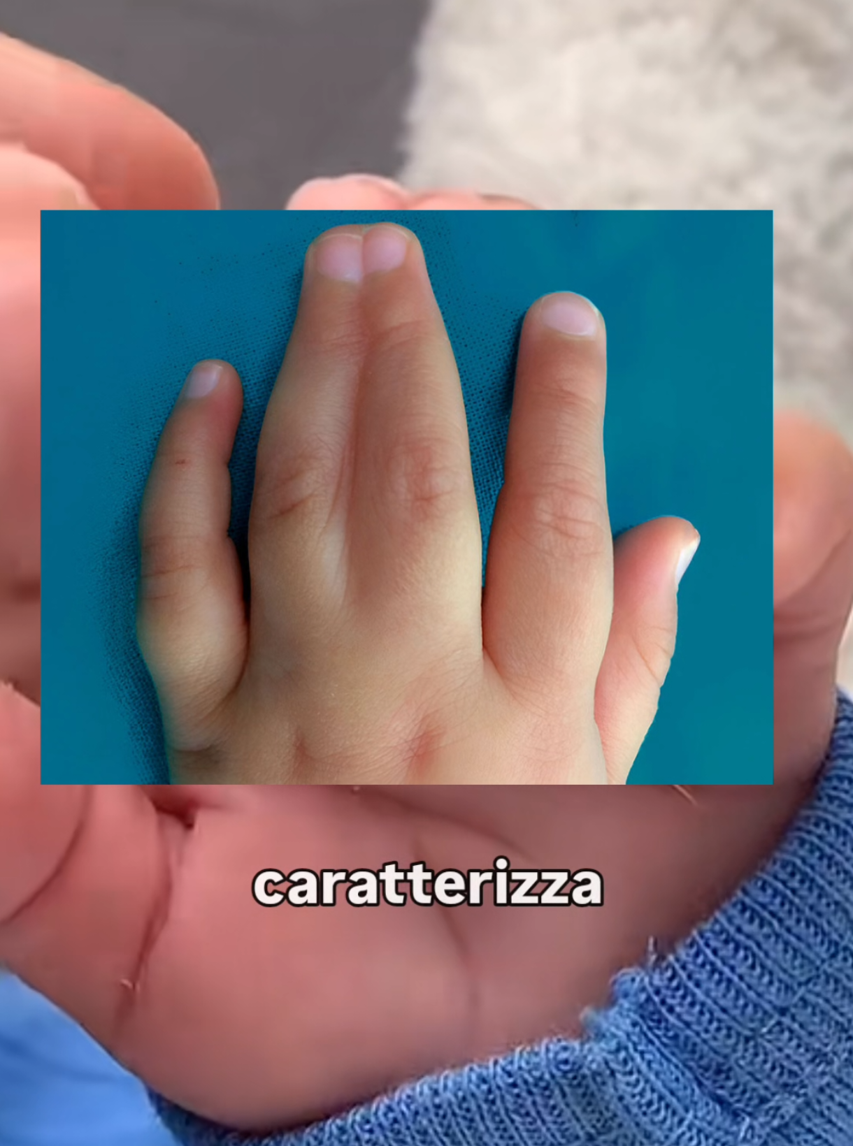 👣 Sindattilia: quando le dita si uniscono! ⁠ 👉 La sindattilia è una malformazione congenita in cui due o più dita delle mani o dei piedi risultano fuse tra loro. ⁠ 🧬 Cause? È spesso genetica (trasmessa familiarmente), ma può anche comparire come parte di sindromi genetiche più complesse. Raramente può essere acquisita dopo traumi o ustioni. ⁠ 🔍 Curiosità: La sindattilia è la malformazione più comune delle mani! Colpisce circa 1 neonato su 2.000. ✂️ Nei casi più evidenti si interviene chirurgicamente, spesso nei primi anni di vita. #medicina #imparare #curiosità #medico #health #salute 