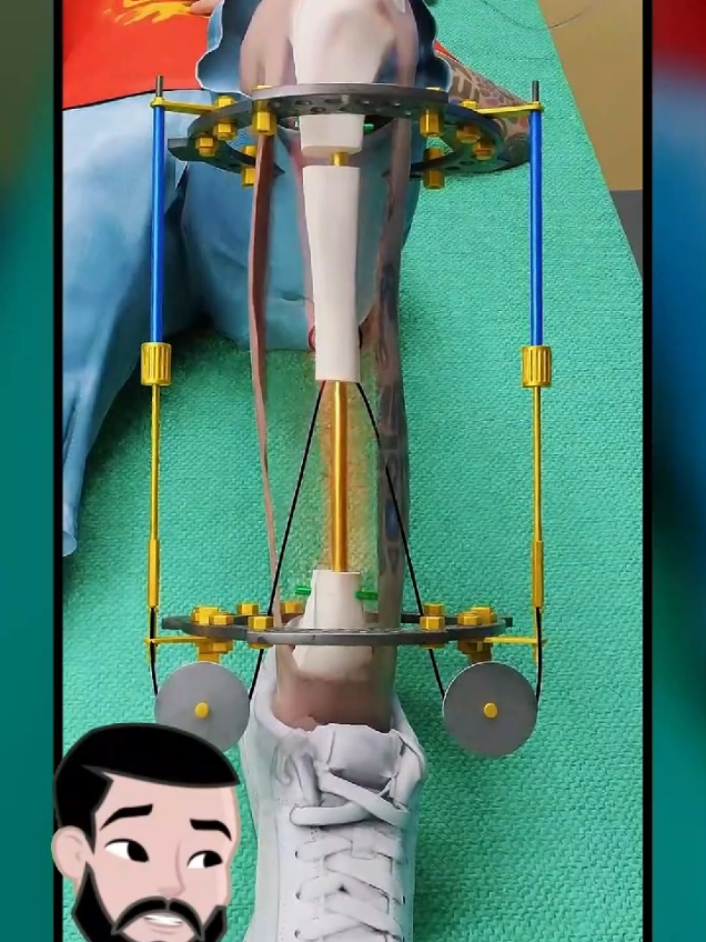 Comment les chirurgiens réparent une jambe fracturée en plusieurs morceaux ? 🔍🦴 Une jambe totalement broyée peut-elle être sauvée ? Grâce à des techniques avancées comme la tige intramédullaire et le fixateur externe circulaire, les médecins parviennent à réaligner les os et favoriser leur guérison naturelle. Une prouesse de la médecine moderne !  #santé #médecine #Science #3danimation #pourtoi 