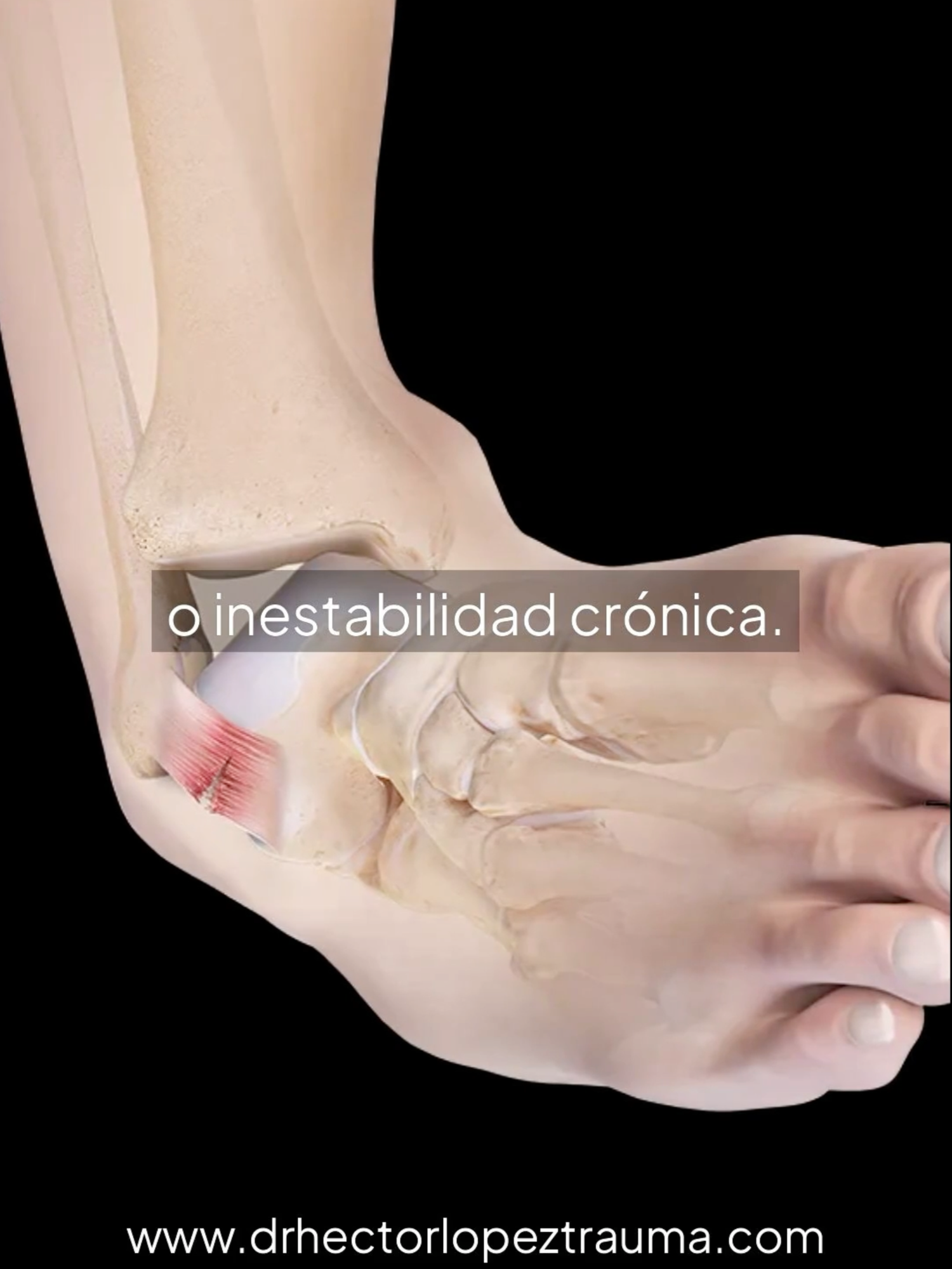 👣 ¿Dolor persistente en el tobillo? No lo dejes pasar ⚠️🦶 El tobillo es clave para tu equilibrio y movilidad. Cuando duele, algo en su estructura puede estar fallando. No esperes a que el dolor limite tu vida diaria. 📲 Agenda tu cita con un especialista en pie y tobillo. 📍 Av Eloy Cavazos 5605, Villa Olímpica, Guadalupe, N.L. 📞 Citas por Whatsapp al: 81 2012 8406 🌐 www.drhectorlopeztrauma.com #tobillo #dolor #pieytobillo #traumatologia #ortopedia #cirugia #dolorarticular #inestabilidad #artritis #fascitis #movilidad #lesion #medicinadeportiva #especialista #equilibrio #bienestar #doctor #checkup #fyp #fypシ