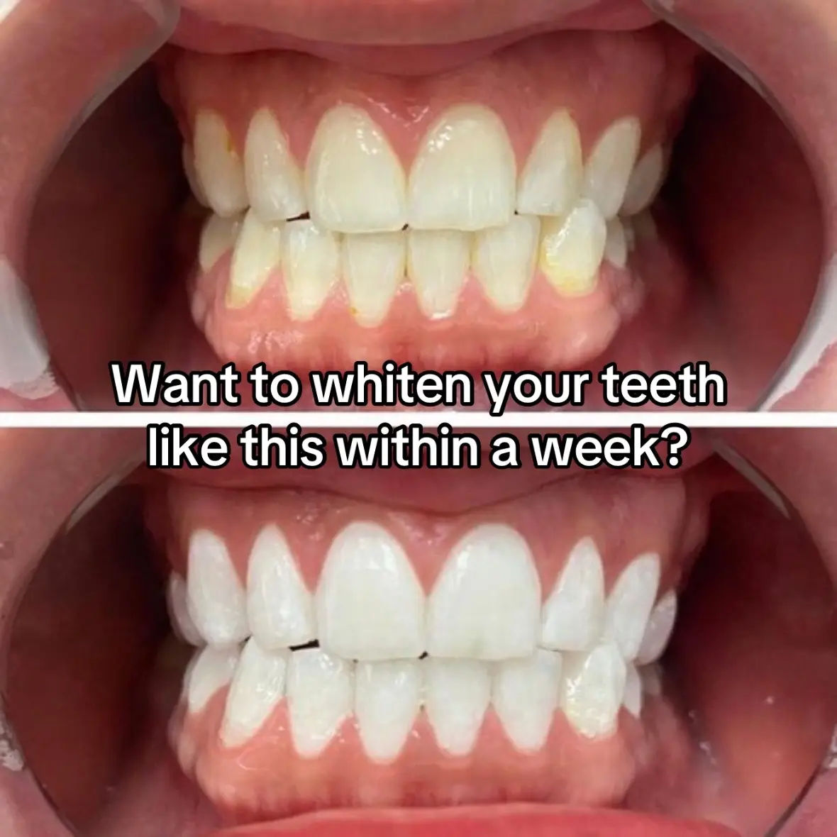 #teethwhitening 