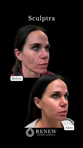 When they ask if you got work done…just smile 😏 #renewoklahoma #aesthetics #GlowUp #transformation #plasticsurgery #cosmetics 