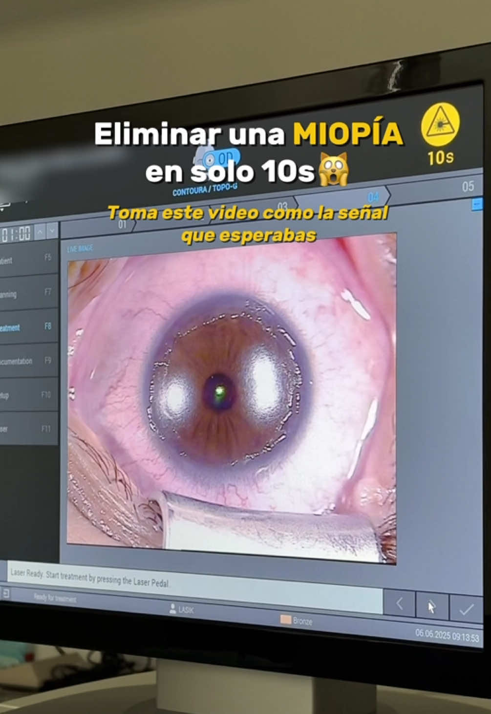 Una cirugía que puede transformar tu calidad de vida👀💙 #miopia #gafas #lentes #astigmatismo #eyesight