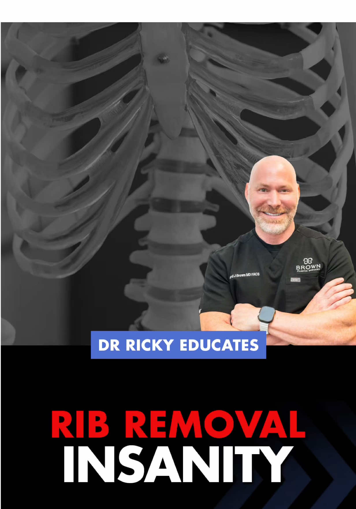 Rib removal is one of those procedures that’s gained viral attention—but few people talk about the real risks involved. As a surgeon, I’m here to say: just because something is technically possible, doesn’t mean it’s safe or recommended. Your ribs are there to protect vital organs. Removing them for aesthetic reasons? It’s invasive, high-risk, and often unnecessary. There are many safer ways to contour the waist with liposculpture or muscle repair. Ask questions. Demand transparency. Stay safe. 💬 … #R#RibRemovalR#RibRemovalRisksC#ComplicationsB#BodyContouringP#PlasticSurgeryA#AestheticSurgeryHealthAwareness