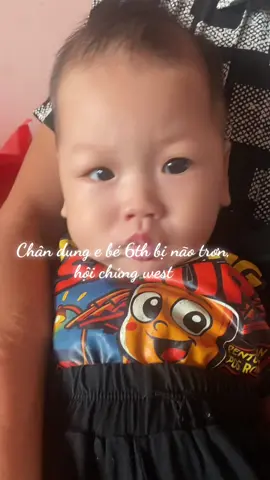 Chân dung e bé 6th bị não trơn và hội chứng west #hoichungwest #bạinão💚 #naotron 
