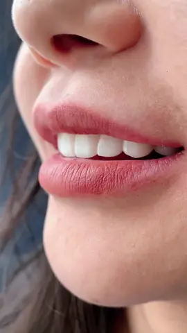 全瓷贴面美牙