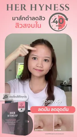 มาส์กที่เกิดมาเพื่อคนเป็นสิว! มาส์กดำลดสิว Her Hyness คุมมัน ลดอุดตัน แถมอ่อนโยน ไม่แสบผิว จัดการปัญหาสิวได้จริง #HerHyness #No1CleanBeauty 