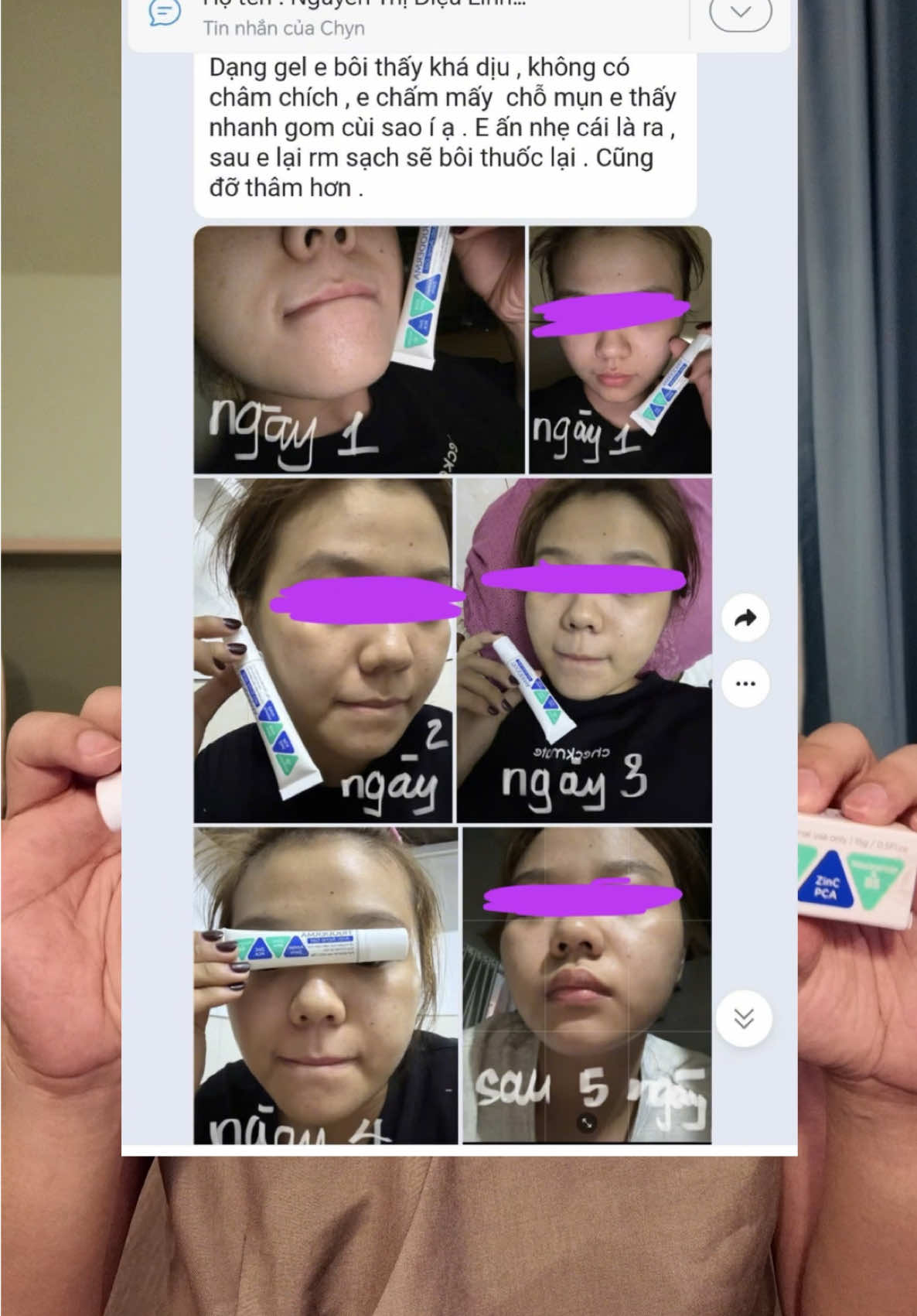 - Kem mụn Trioderma test lên test xuống trên 15 bạn - Chưa bao giờ phải khổ tới vậy. Haha #cunghocchamda #reviewlamdep #chamsocda #trioderma 