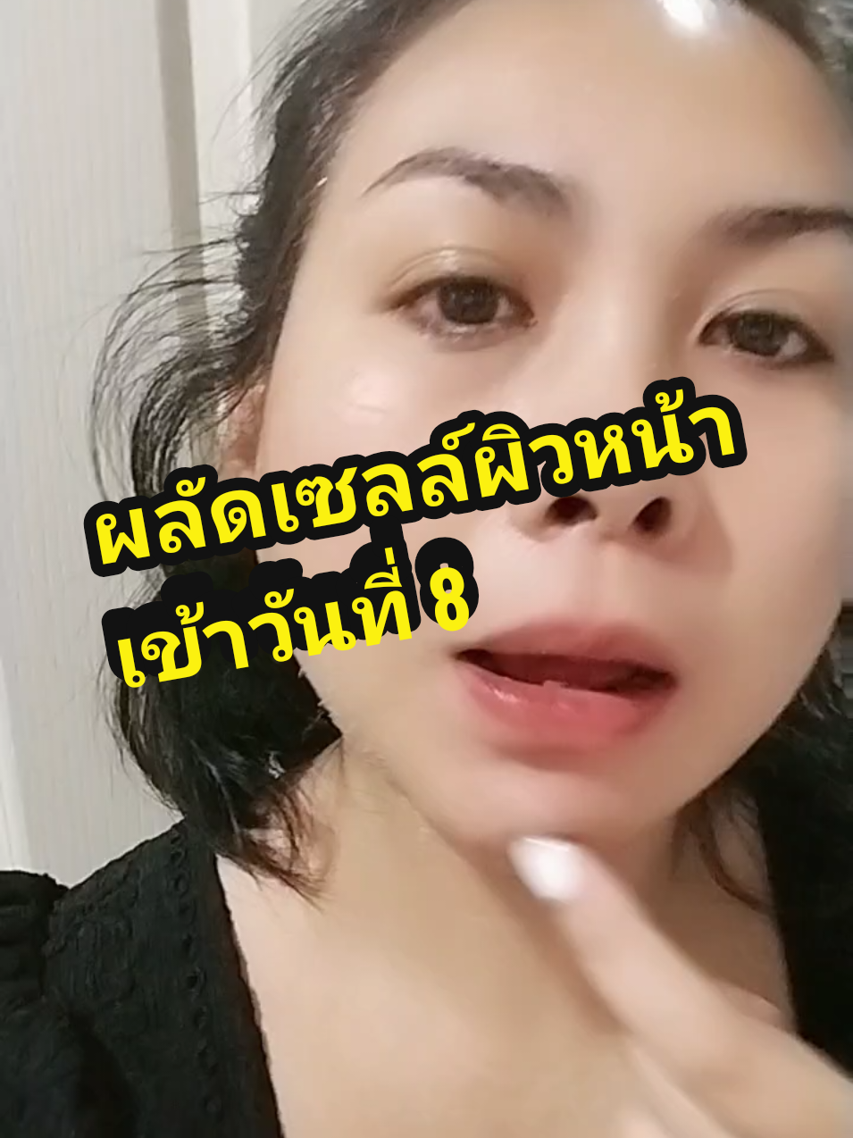 ผลัดเซลล์ผิวหน้าห้องวันที่ 8#ผลัดเซลล์ผิว #ผลัดเซลล์ผิวหน้า #dermaskin #หน้าใสไร้สิว #ลดฝ้ากระจุดด่างดํา #รีวิวสกินแคร์ 