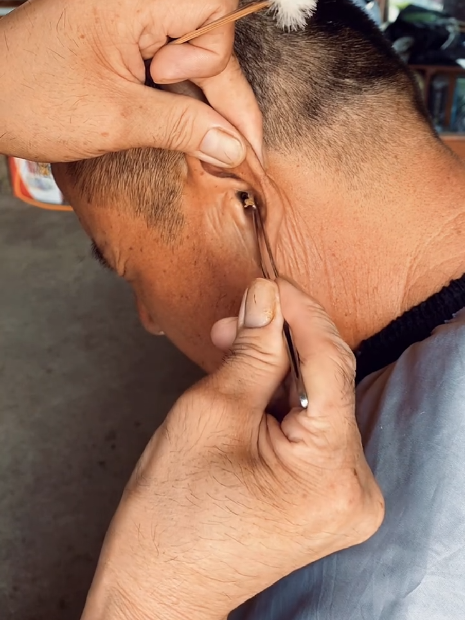 keratin plug blockage  #earwax 