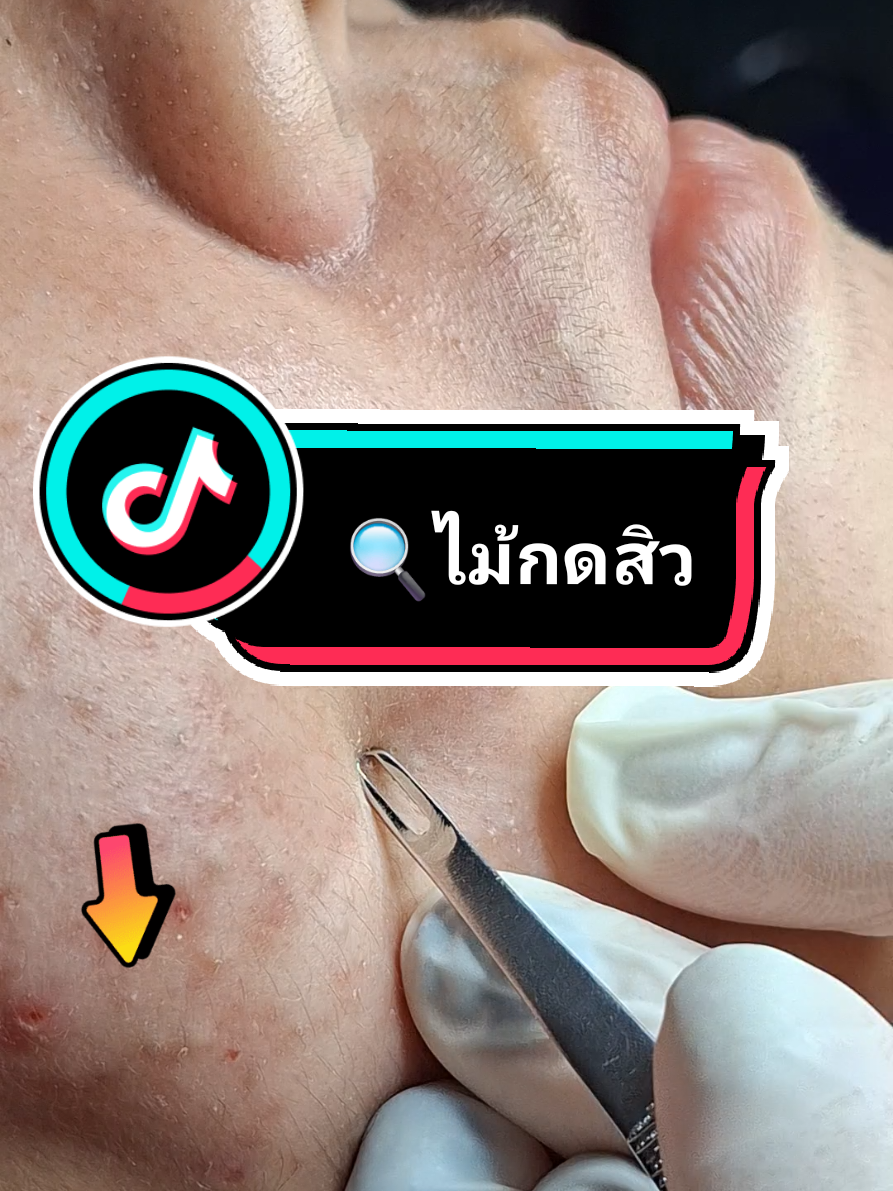 #ไม้กดสิว #ไม้กดสิวหมอมวลชน ใช้ #กดสิว #สิวอุดตัน #กดสิวอุดตัน #พี่กุ้งกดสิว #เทคนิคพี่กุ้งกดสิว 