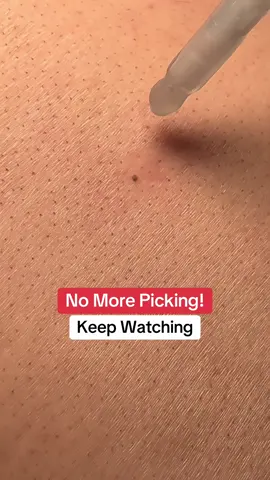 Dr. Melaxin Peel Shot for black heads and white heads really works! #blackhead #whiteheads #peelshot #drmelaxin #drmelaxinpeelshot  #exfoliating #skincare #skincareroutine @Dr.Melaxin Global #tiktokshopcreatorpicks 