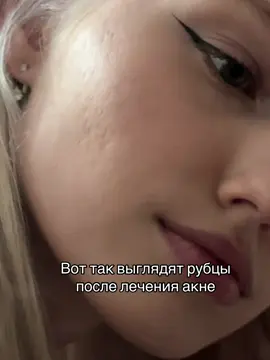 Особо их и не видно, но эт с какой стороны и под каким светом посмотреть🙃 #acne #системныеретиноиды #девушкасакне #модельсакне 