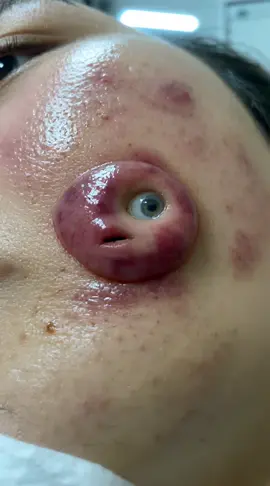 Dangerous pimple removal #pimples 
