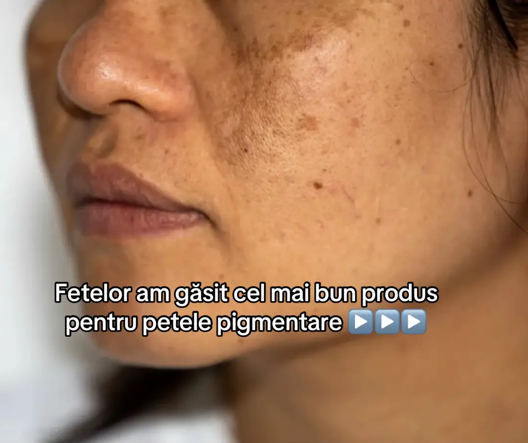 @COSRX Official  #ByeByeDarkSpots #FadeHyperpigmentation #DarkSpotCorrector #HyperpigmentationTreatment #PigmentationSolution #EvenSkinTone #COSRX #COSRXSkincare #AlphaArbutin #TranexamicAcid #COSRXR