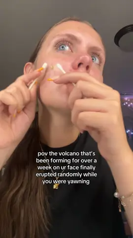 i’ve never seen so much come out of a pimple in my life (also i was sending a video to my cousin so that’s why im yapping 😭) #asmr #satisfying #pimple #pimplepopping #tired #fyp 