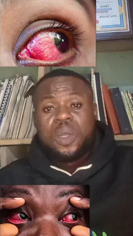 Solution to eye 👁️ problem #eyes #creatorsearchinsight #goviral #trandingvideo #tranding #fypシ゚ #fyp 