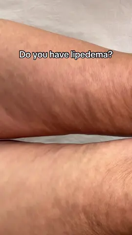Do you struggle with lipedema? #kiinnysports #workout #pilates #legworkout #unitedstates 