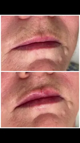 💋 Thinking about enhancing your lips or adding volume to your mid-cheek area? Dermal fillers can work wonders! ✨  Whether you want a subtle plump or a more dramatic change, fillers can help create a balanced and youthful appearance. They’re designed to enhance your natural beauty while providing a boost of hydration and volume.  Here’s what to know about using dermal fillers for lips and cheeks: 1️⃣ Lips: Achieve that perfect pout or smooth out fine lines around the mouth. 2️⃣ Mid-Cheek: Add contour and lift to your face, giving you a youthful glow. 3️⃣ Natural Look: Skilled injectors can create natural-looking results tailored to your facial structure. 4️⃣ Quick Recovery: Most people are back to their routine within a day or two! #LipEnhancement #CheekVolume #BeautyBoost