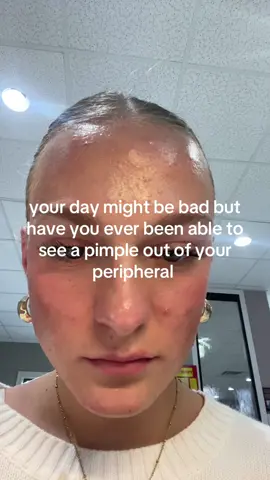 #acne #acneproneskin #pimple #acnetreatment #acnescars 