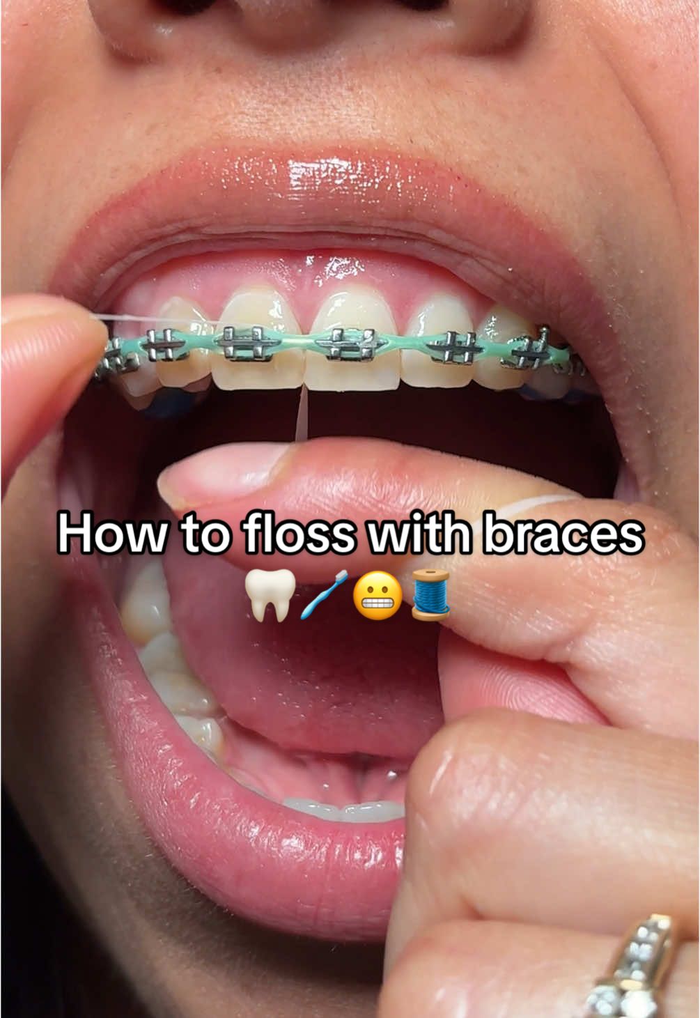 Part 1| HOW TO FLOSS WITH BRACES🦷STRING FLOSS🦷 A lot of you guys have been asking for a video on how to floss with braces😬 here’s one way of many ways👌@OralB #braces #bracescolors #bracesoff #bracestips #bracescheck #adultbraces #bracesjourney #flossing #oralhealth #oralcare #OralB #oralhygiene #oralb #dental #dentist #dentistry #ortho #orthodontist 