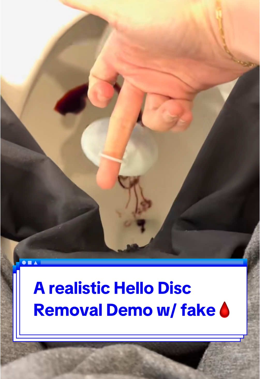 A reminder for the nonbelievers that this is the original and easiest to remove looped tab menstrual disc 💅#cuptok #periodtok  #onthisday 