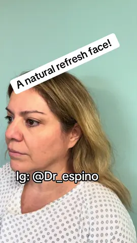A beautiful and natural refresh face! #EspinoLift #Fyp #Parati #Tijuana #RejuvenecimientoFacial #SanDiego #Arizona 