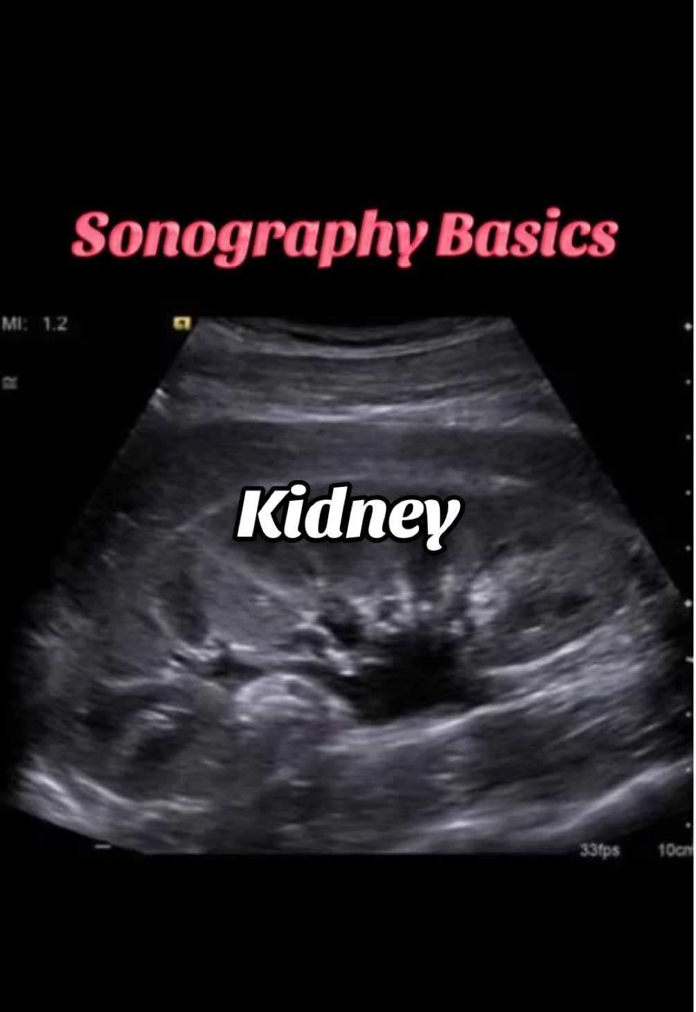 Sonoquiz #2 #kidneys  I start clinicals in a couple weeks but posting what I’ve learned helps me keep the knowledge fresh, so more to come!... Comment, like, and share 🤗. #sonography #ultrasound #sonotok #medschool #organs #sonographybasics 