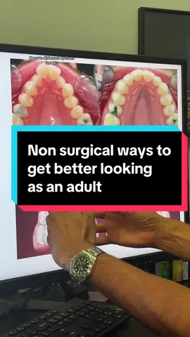 Non surgical ways to get better looking as an adult #nonsurgialfacelift #nonsurgicaltreatments #jawexpansion #myofunctionaltherapy #expander #beauty #beautyhacks #beautytips #looks #truth #rootcause 